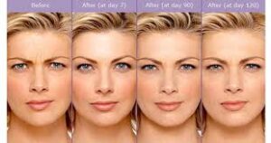 Before and after photos of Botox treatment of the frown lines