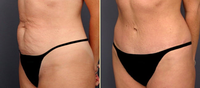 A female patient's tummy tuck before and after in Atlanta. On the left 