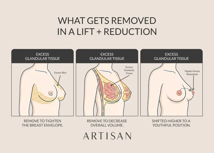 How do breast lifts with reduction results appear in galleries?