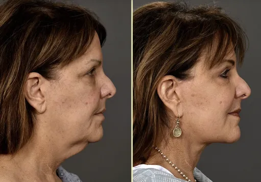 What Causes Jowls, Platysma Bands, and Jawline Sagging?