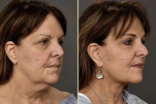 What Is a Lower Facelift and Neck Lift, and What Does It Actually Fix?