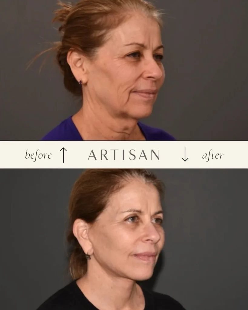 What are the main benefits of a deep plane facelift?