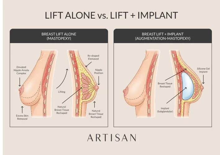 What do before-and-after photos of a breast lift combined with augmentation show?