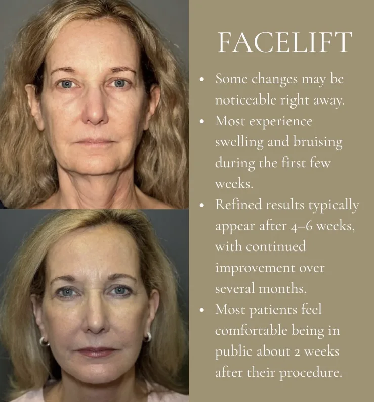 What is recovery like after a deep plane facelift?