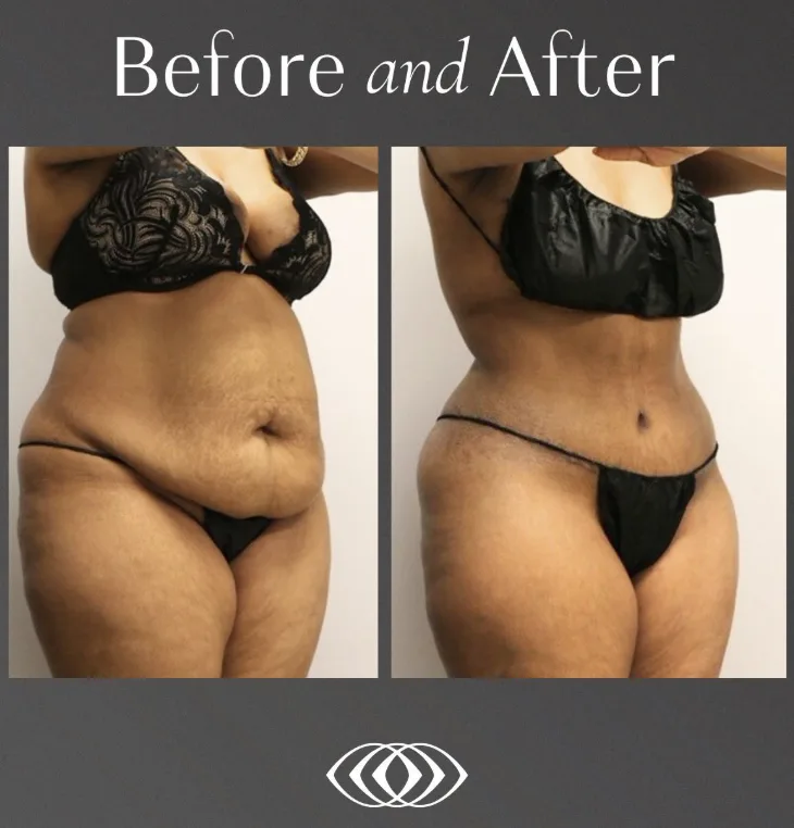 What happens to the belly button during tummy tuck surgery?