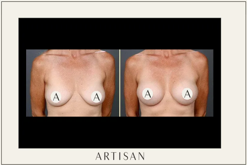 What is recovery like during the first week after breast augmentation?