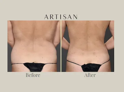Who qualifies for liposuction, and what happens at a consultation?