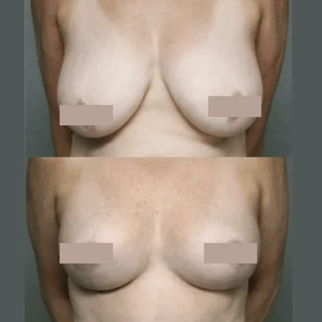 How can I tell whether I need a lift, implants, or both?