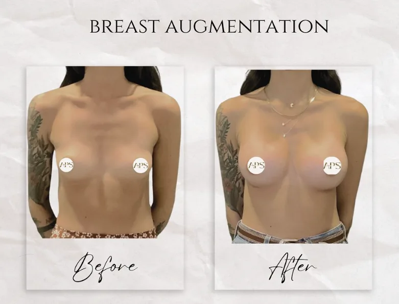 What makes breast augmentation results look natural?