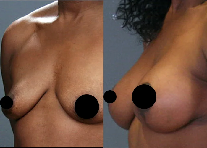 What payment and financing options make a breast lift affordable?