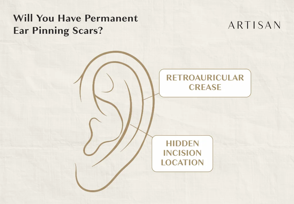 Will you have permanent ear pinning scars?