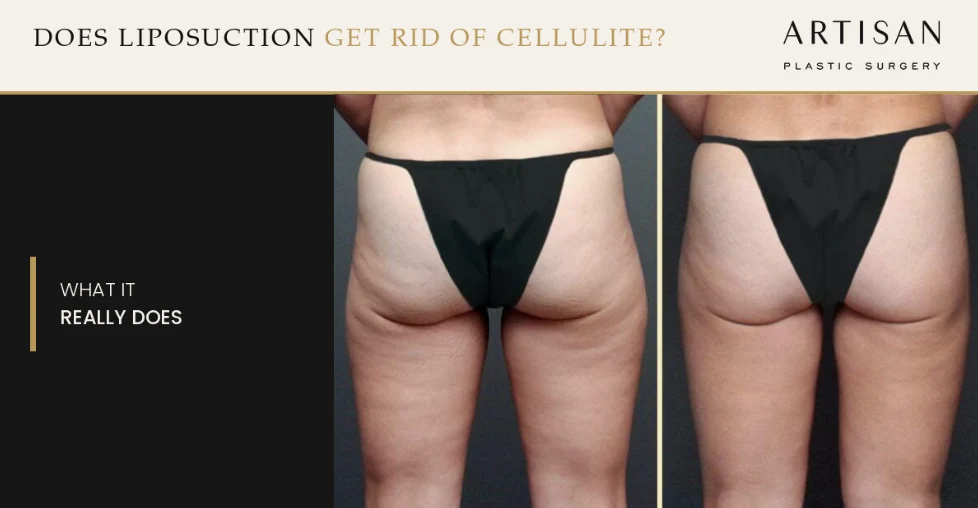 Does Liposuction Get Rid of Cellulite? What It Really Does