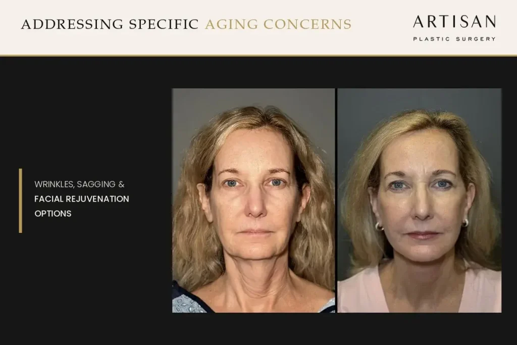 Best Face Procedure for Wrinkles, Sagging, and Lost Volume